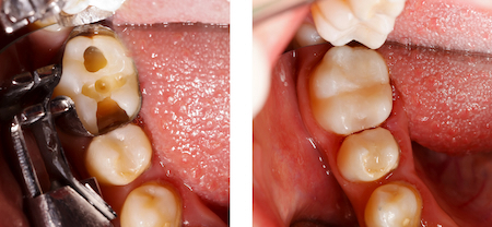 Tooth-Colored Fillings