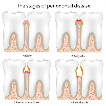 Periodontal Disease & Treatment