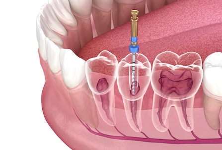 Root Canal Treatment