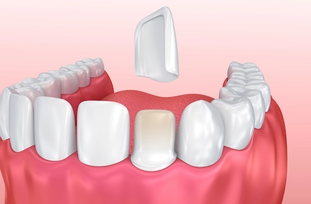 Veneers and Laminates